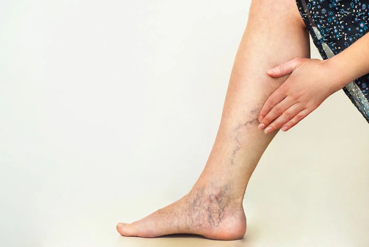 Oil for Varicose Veins: Natural Solutions for Relief and Management